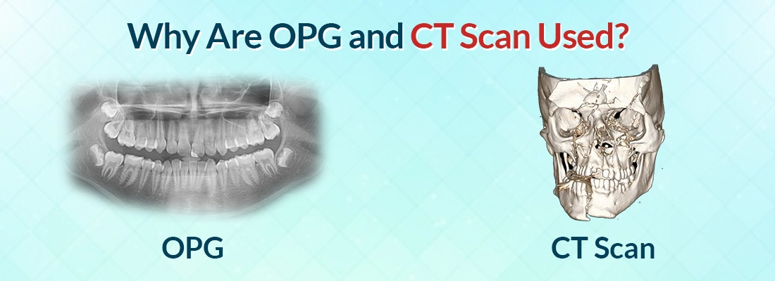 OPG And CT Scans Used